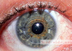 Острое нарушение зрения при кератоконусе. Способы консервативного и хирургического лечения с отсутствием рецидивов
