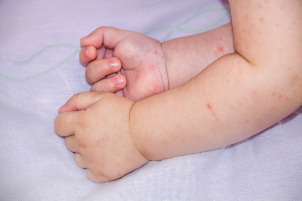 Сыпь у ребенка ноги руки холодные thumbnail