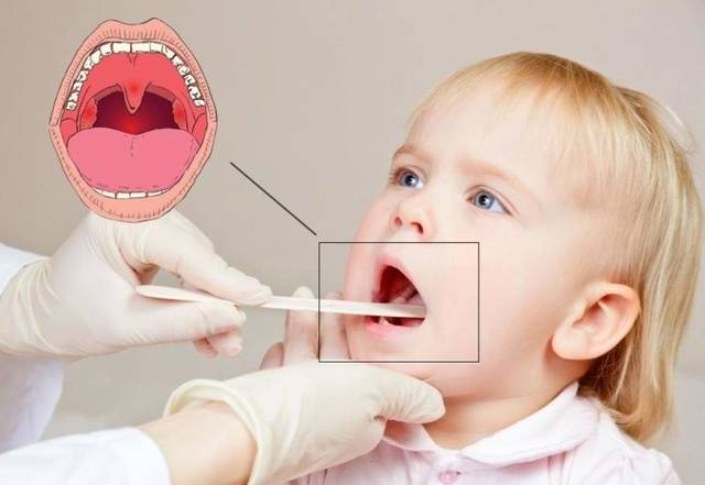 Как и чем лечить горло ребенку?