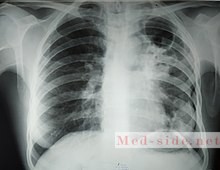 Что такое туберкулез в 21 веке, органы мишени и расшифровка диагноза с МБТ и МЛУ