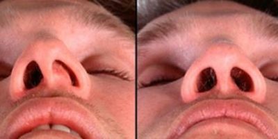 Перегородка носа