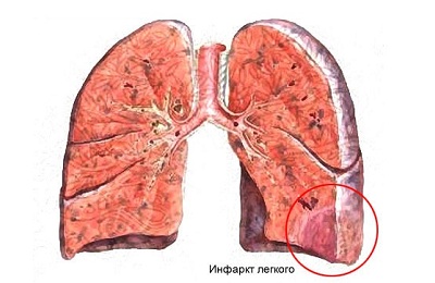 Инфильтраты в легких после пневмонии thumbnail