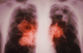 туберкулез легких