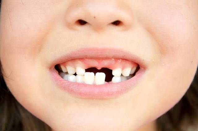 Фото страшных зубов у детей