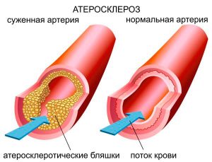 Артеросклероз