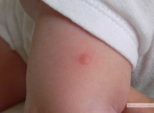 Как уберечь себя и ребёнка от осложнений после укуса насекомых: рекомендации для оказания первой помощи
