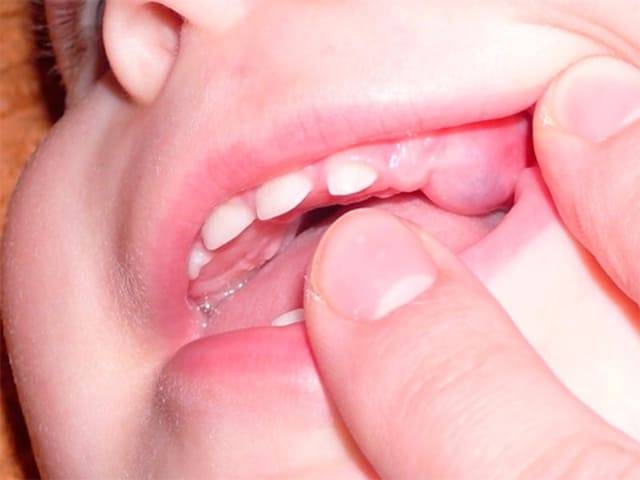 Симптомы прорезывание зубов у детей