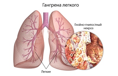 Как облегчить дыхание при пневмонии thumbnail