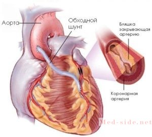 Список патологий, которые называются ишемической болезнью сердца. Как вовремя распознать и просчитать риск внезапной смерти