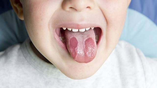 Стоматит у ребенка во рту на языке фото