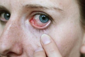 Симптомы проникновения паразита в глаз