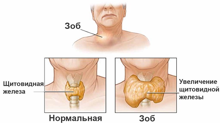 Увеличение щитовидки