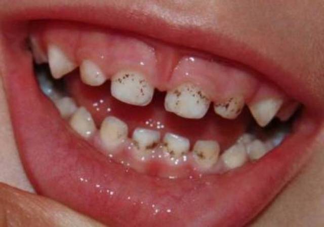 Черный налет на зубах у ребенка