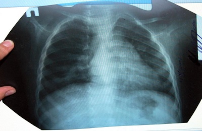 На рентгенограмме при пневмонии инфильтрация thumbnail
