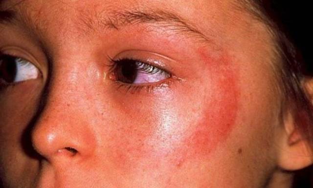 Аллергия на солнце у детей
