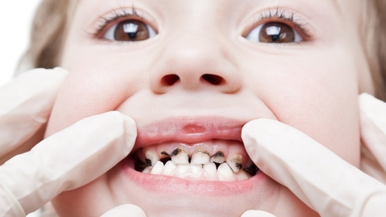 Кариес зубов картинки для детей дантистофф