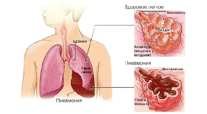 Чем лечат пневмонию после гриппа thumbnail
