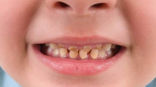Желтые зубы у ребенка