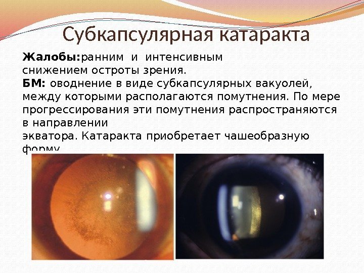 Субкапсулярная катаракта
