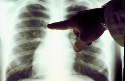 Расшифровка рентгена легких при пневмонии thumbnail