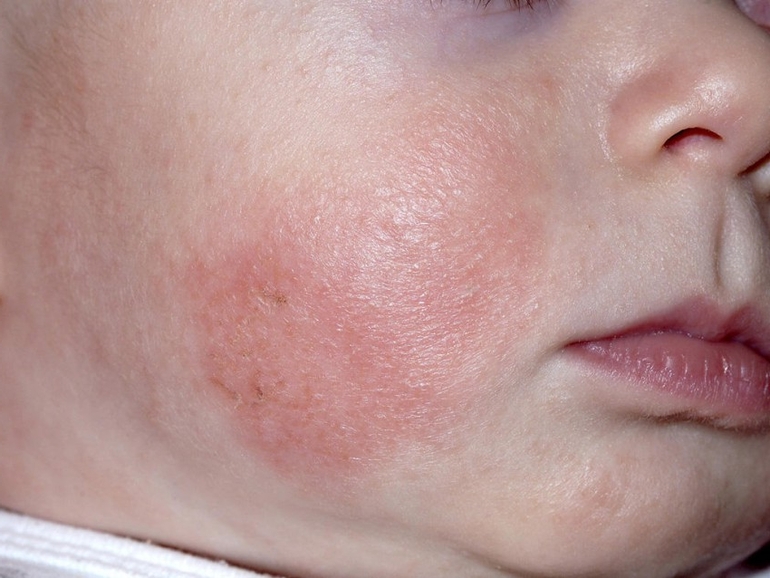Причины и лечение дерматита у детей