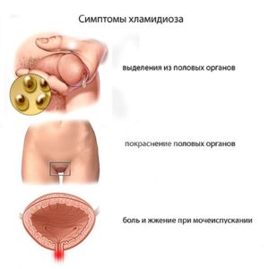Симптомы хламидиоза