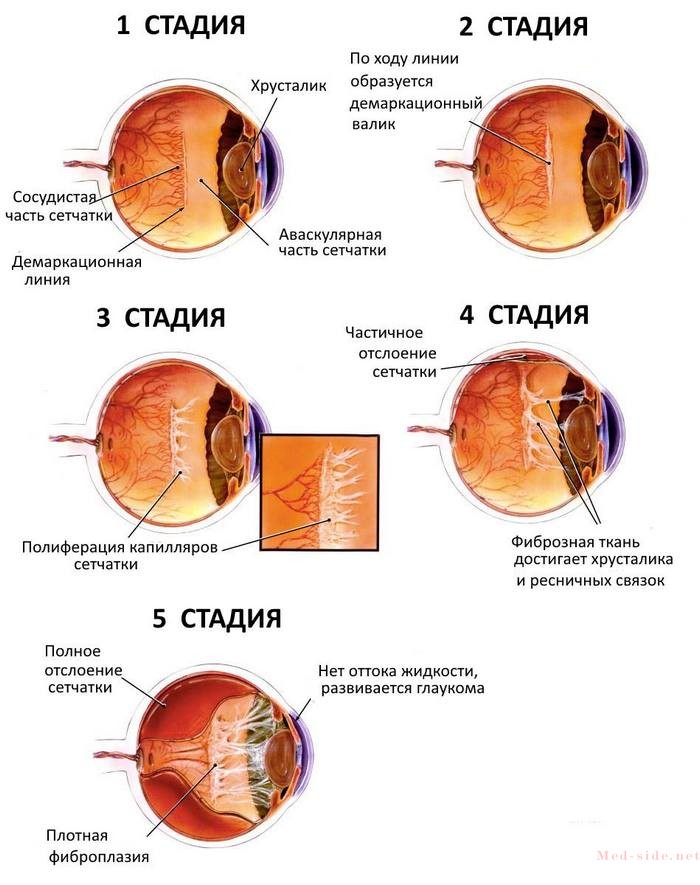 Советы неонатолога: как вовремя распознать и вылечить ретинопатию недоношенных