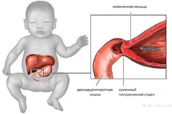 Основные проявления пилоростеноза у новорожденных и способы его лечения по европейским рекомендациям