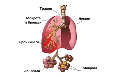 Бронхиальная астма и бронхит таблица thumbnail