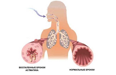 Тахикардия при бронхиальной астме thumbnail