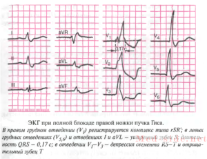 Детальный разбор блокад сердца. возможности диагностика на ЭКГ и показания к постановке стимулятора